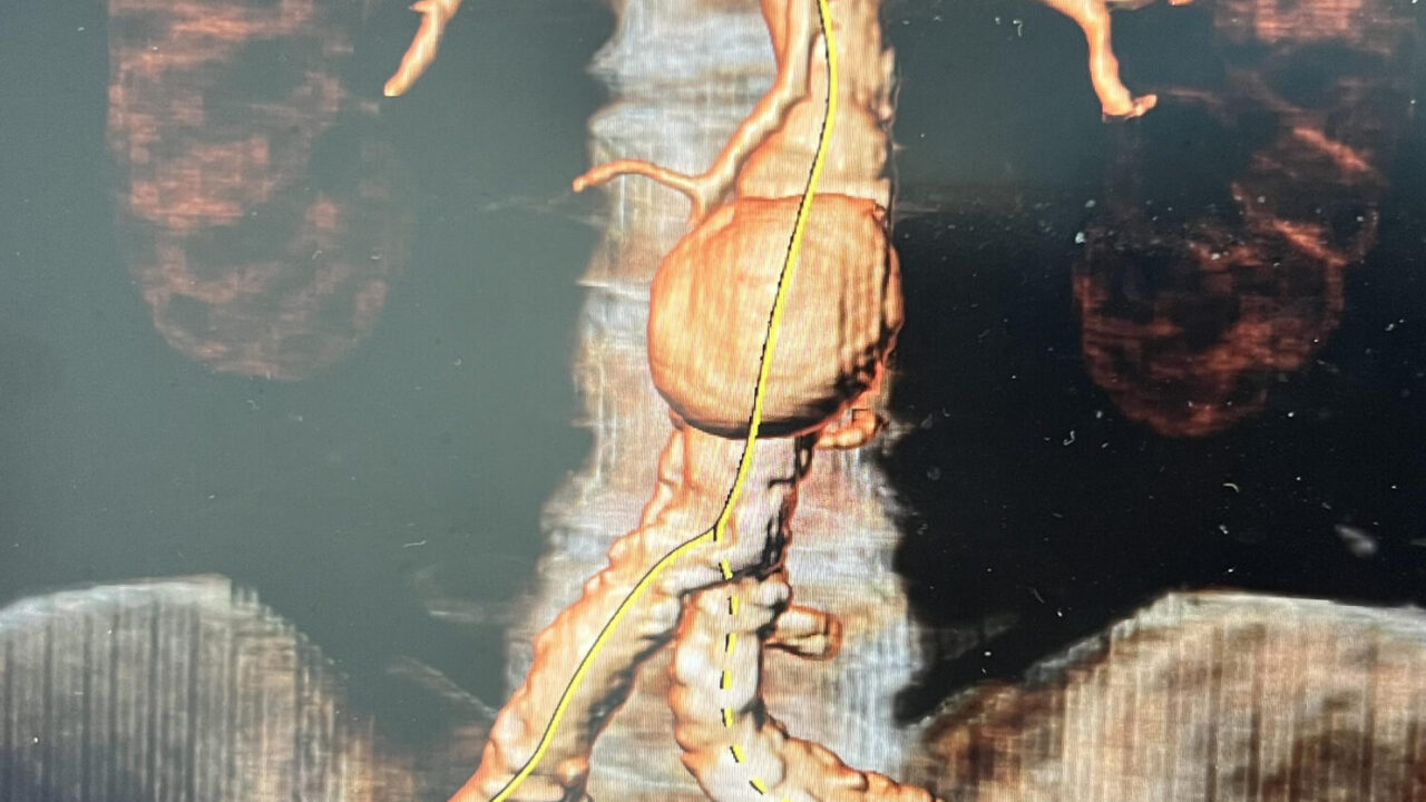 Aneurisma de aorta | Tratamiento y valoración | Cartagena